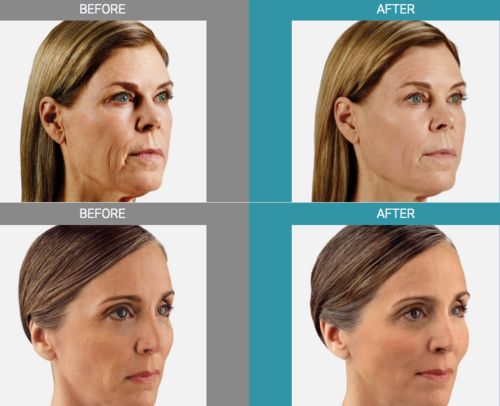 buy juvederm filler online buy juvederm filler online buy juvederm filler online buy juvederm filler online buy juvederm filler online buy juvederm filler online buy juvederm filler online buy juvederm filler online buy juvederm filler online buy juvederm filler online buy juvederm filler online buy juvederm filler online buy juvederm filler online buy juvederm filler online buy juvederm filler online buy juvederm filler online buy juvederm filler online buy juvederm filler online buy juvederm filler online buy juvederm filler online buy juvederm filler online buy juvederm filler online buy juvederm filler online buy juvederm filler online buy juvederm filler online buy juvederm filler online buy juvederm filler online buy juvederm filler online buy juvederm filler online buy juvederm filler online buy juvederm filler online buy juvederm filler online buy juvederm filler online buy juvederm filler online buy juvederm filler online buy juvederm filler online buy juvederm filler online buy juvederm filler online buy juvederm filler online buy juvederm filler online buy juvederm filler online buy juvederm filler online buy juvederm filler online buy juvederm filler online buy juvederm filler online buy juvederm filler online buy juvederm filler online buy juvederm filler online buy juvederm filler online buy juvederm filler online buy juvederm filler online buy juvederm filler online buy juvederm filler online buy juvederm filler online buy juvederm filler online buy juvederm filler online buy juvederm filler online buy juvederm filler online buy juvederm filler online buy juvederm filler online buy juvederm filler online buy juvederm filler online buy juvederm filler online buy juvederm filler online buy juvederm filler online buy juvederm filler online buy juvederm filler online buy juvederm filler online buy juvederm filler online buy juvederm filler online buy juvederm filler online buy juvederm filler online buy juvederm filler online buy juvederm filler online buy juvederm filler online buy juvederm filler online buy juvederm filler online buy juvederm filler online buy juvederm filler online buy juvederm filler online buy juvederm filler online buy juvederm filler online buy juvederm filler online buy juvederm filler online buy juvederm filler online buy juvederm filler online buy juvederm filler online buy juvederm filler online buy juvederm filler online buy juvederm filler online buy juvederm filler online buy juvederm filler online buy juvederm filler online buy juvederm filler online buy juvederm filler online buy juvederm filler online buy juvederm filler online buy juvederm filler online buy juvederm filler online buy juvederm filler online buy juvederm filler online buy juvederm filler online buy juvederm filler online buy juvederm filler online buy juvederm filler online buy juvederm filler online buy juvederm filler online buy juvederm filler online buy juvederm filler online buy juvederm filler online buy juvederm filler online buy juvederm filler online buy juvederm filler online buy juvederm filler online buy juvederm filler online buy juvederm filler online buy juvederm filler online buy juvederm filler online buy juvederm filler online buy juvederm filler online buy juvederm filler online buy juvederm filler online buy juvederm filler online buy juvederm filler online
