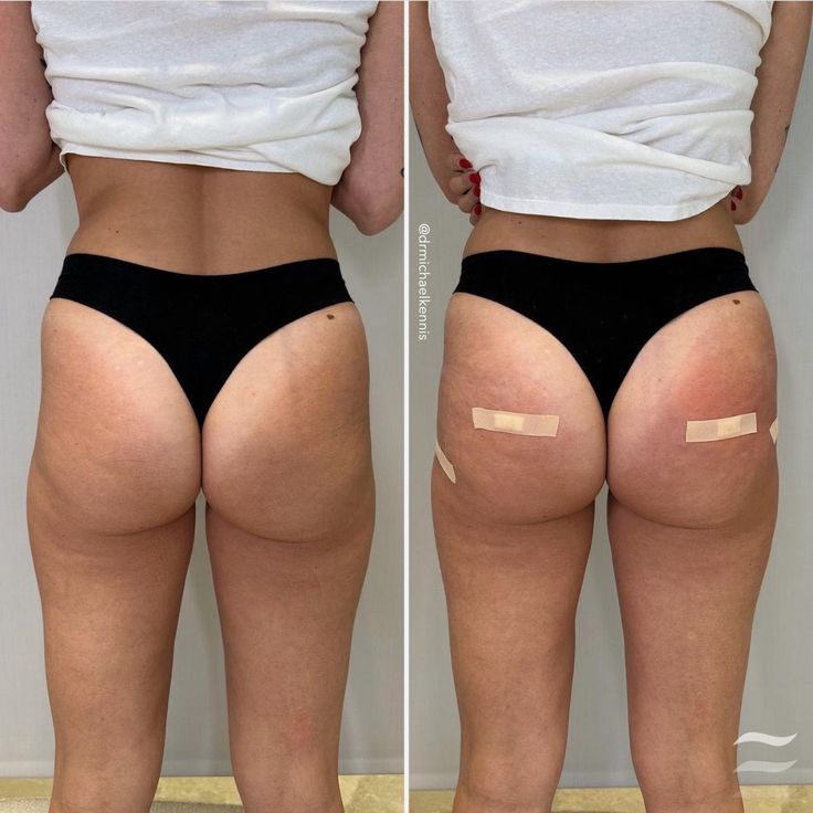 Sculptra Filler for Butt Lift