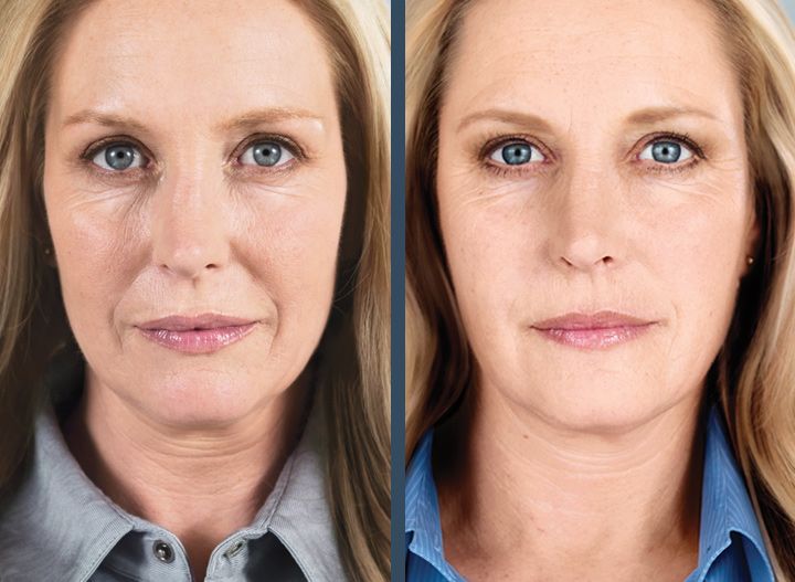 Sculptra Filler