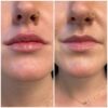 Buy Revanesse Versa Lips+ online Purchase Revanesse Versa Lips+ Order Revanesse Versa Lips+ filler Revanesse Versa Lips+ for sale Revanesse Versa Lips+ supplier Revanesse Versa Lips+ wholesale Where to buy Revanesse Versa Lips+ Revanesse Versa Lips+ authorized distributor Best price Revanesse Versa Lips+ Shop Revanesse Versa Lips+ filler Hyaluronic acid lip filler Lip augmentation dermal filler FDA-approved lip filler Long-lasting lip filler Non-surgical lip enhancement Lip filler with minimal swelling Natural-looking lip filler results Revanesse lip filler reviews Lip filler for volume and symmetry Best filler for lips 2025