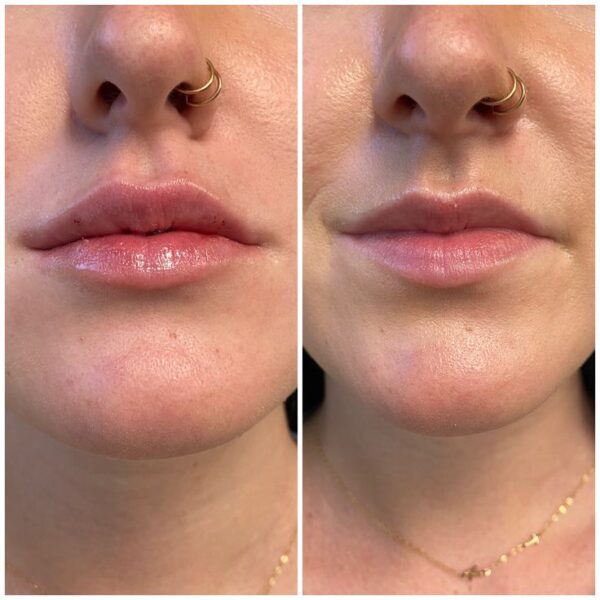 Buy Revanesse Versa Lips+ online Purchase Revanesse Versa Lips+ Order Revanesse Versa Lips+ filler Revanesse Versa Lips+ for sale Revanesse Versa Lips+ supplier Revanesse Versa Lips+ wholesale Where to buy Revanesse Versa Lips+ Revanesse Versa Lips+ authorized distributor Best price Revanesse Versa Lips+ Shop Revanesse Versa Lips+ filler Hyaluronic acid lip filler Lip augmentation dermal filler FDA-approved lip filler Long-lasting lip filler Non-surgical lip enhancement Lip filler with minimal swelling Natural-looking lip filler results Revanesse lip filler reviews Lip filler for volume and symmetry Best filler for lips 2025
