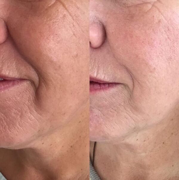 Buy Profhilo online Purchase Profhilo injection Order Profhilo treatment Where to buy Profhilo Profhilo for sale Profhilo online supplier Profhilo wholesale Profhilo injectable buy Shop Profhilo filler Buy Profhilo for clinic Profhilo skin booster buy Injectable moisturizer Bioremodeling treatment Hyaluronic acid skin booster Non-surgical skin rejuvenation Skin booster injection Anti-aging injectable Collagen-stimulating filler Natural skin filler Profhilo before and after Profhilo treatment cost How does Profhilo work Profhilo vs dermal fillers Profhilo neck treatment Profhilo face results Profhilo injection points