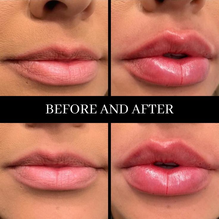 Where to Buy Authentic Juvederm UltraXC