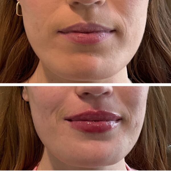 Buy Juvederm Ultra XC Order Juvederm Ultra XC online Juvederm Ultra XC for sale Where to buy Juvederm Ultra XC Purchase Juvederm Ultra XC wholesale Juvederm Ultra XC suppliers Juvederm Ultra XC price online Buy dermal fillers online Juvederm Ultra XC with lidocaine Order lip fillers online Shop Juvederm Ultra XC USA/UK/EU Wholesale Juvederm dermal fillers Authentic Juvederm Ultra XC online Buy Juvederm Ultra XC in bulk Juvederm lip filler Best lip filler for volume Juvederm Ultra vs Juvederm Volbella How long does Juvederm Ultra XC last Juvederm Ultra XC results Hyaluronic acid dermal filler Non-surgical lip enhancement Dermal fillers with lidocaine Juvederm for smile lines Lip filler for natural look Juvederm before and after Filler for nasolabial folds FDA-approved lip fillers Juvederm filler reviews Juvederm Ultra XC treatment areas